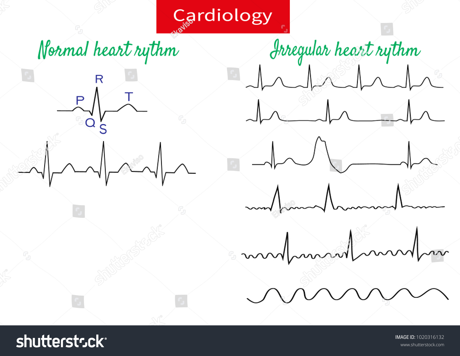 Normal Pathological Ecg Collectionvector Illustration Stock Vector ...