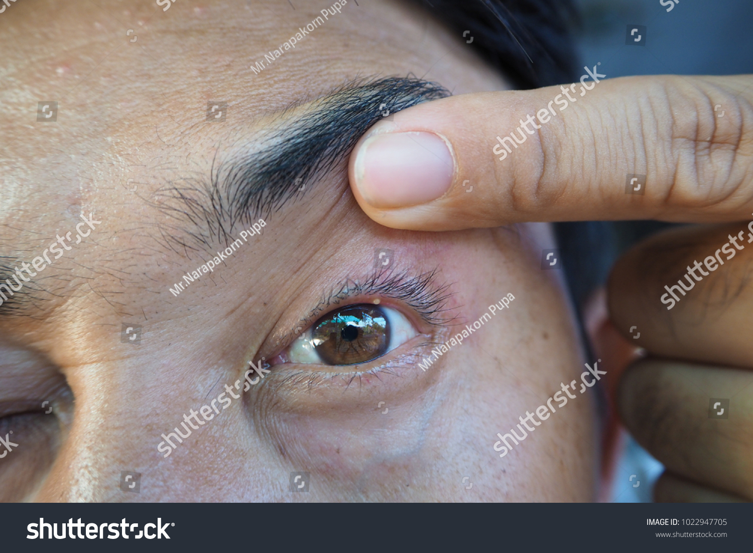 blister-on-upper-eyelid-foto-stok-1022947705-shutterstock