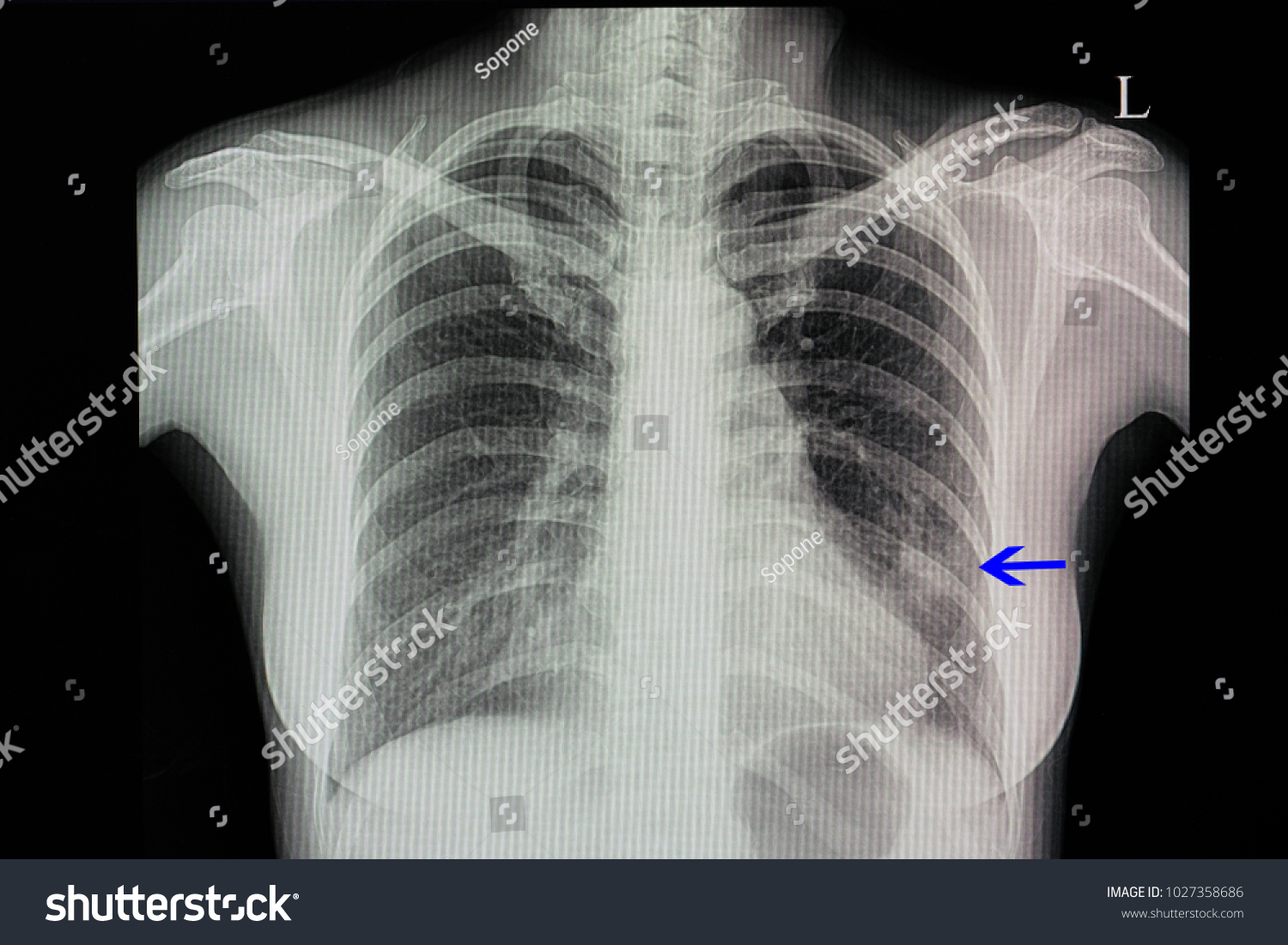 Chest Xray Patient Pneumonia Left Lower Stock Photo 1027358686 ...