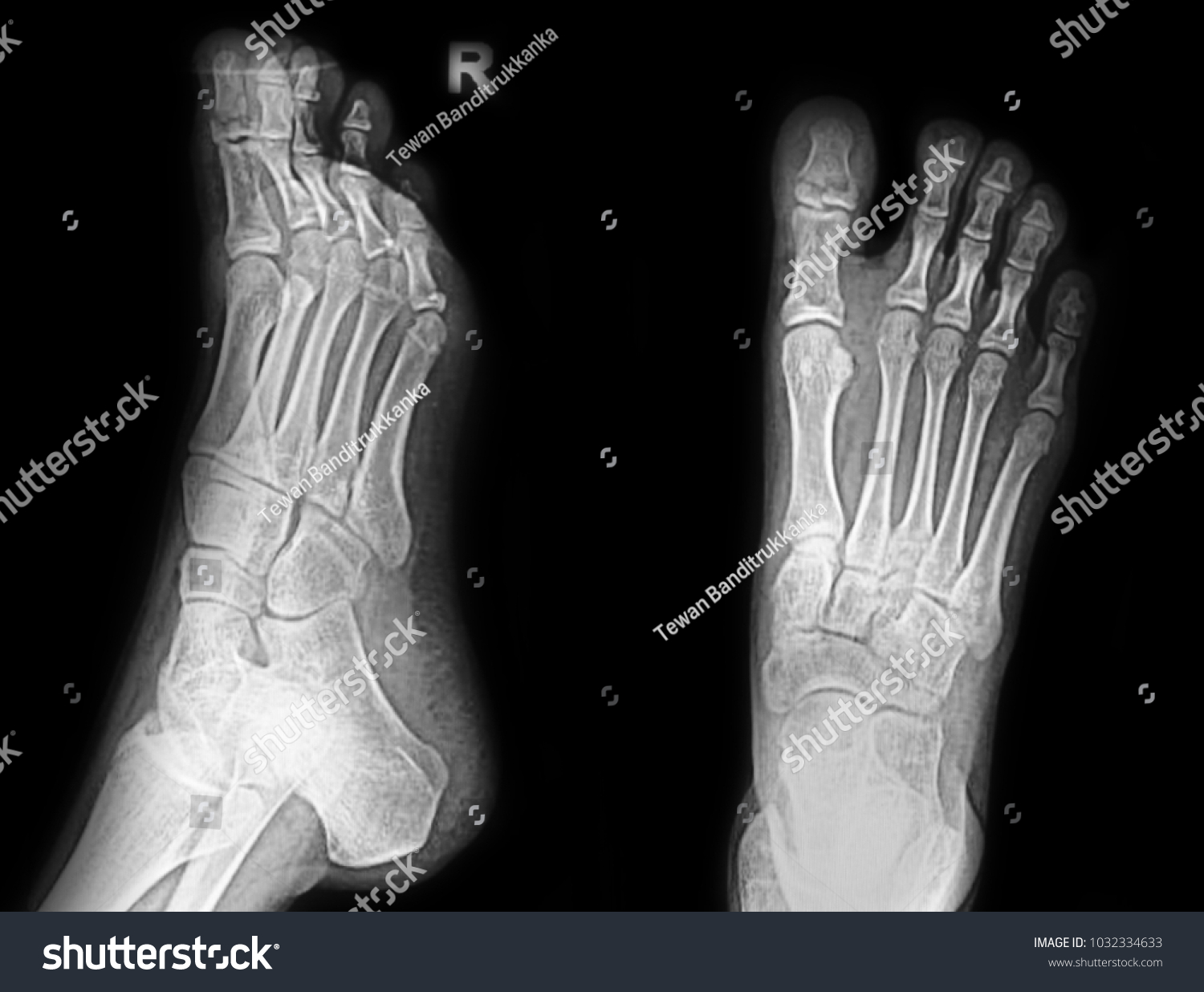 Xray Foot Stock Photo 1032334633 | Shutterstock