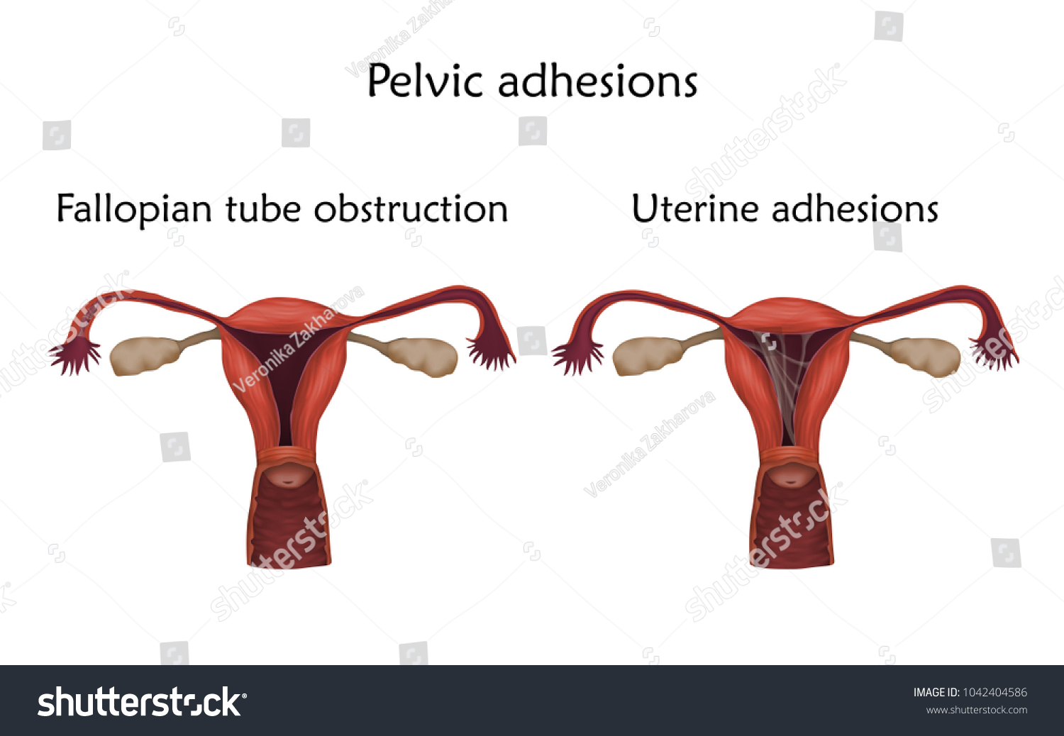 Pelvic Adhersions Uterine Adhesions Fallopian Tube Stock Vector ...