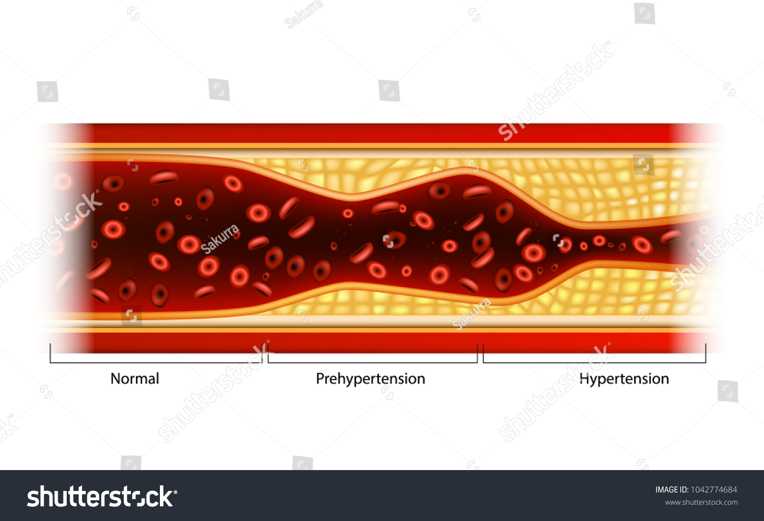 Hypertension Prehypertension Plaque Blood Vessels Stock Vector (Royalty ...