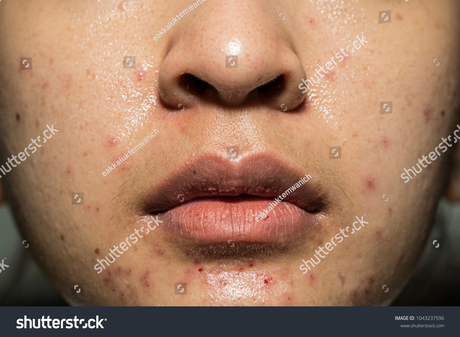 Acne Skin Because Disorders Sebaceous Glands Stock Photo 1043237596