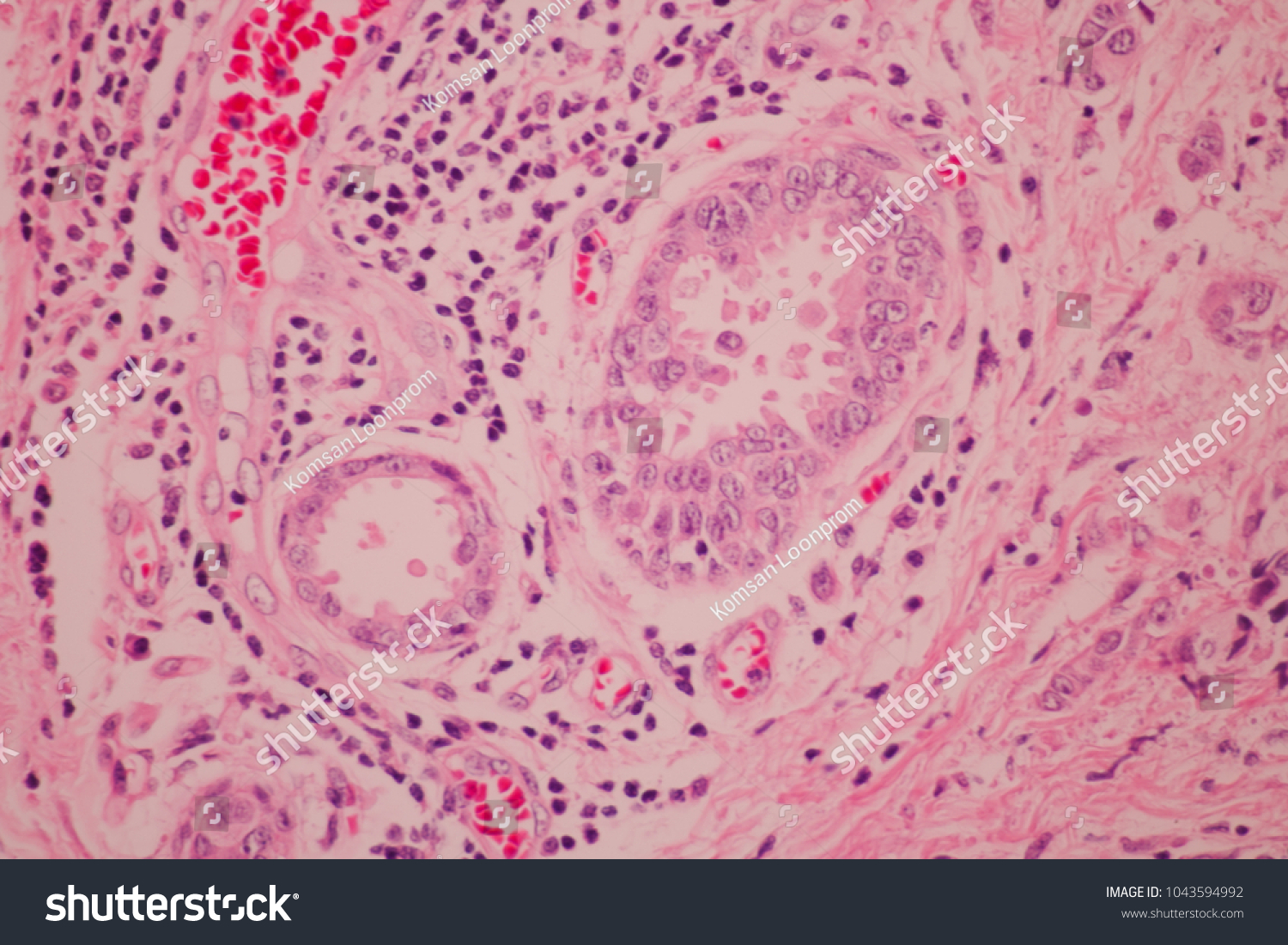 View Microscopic Pathology Section Ductal Cell Stock Photo 1043594992 ...