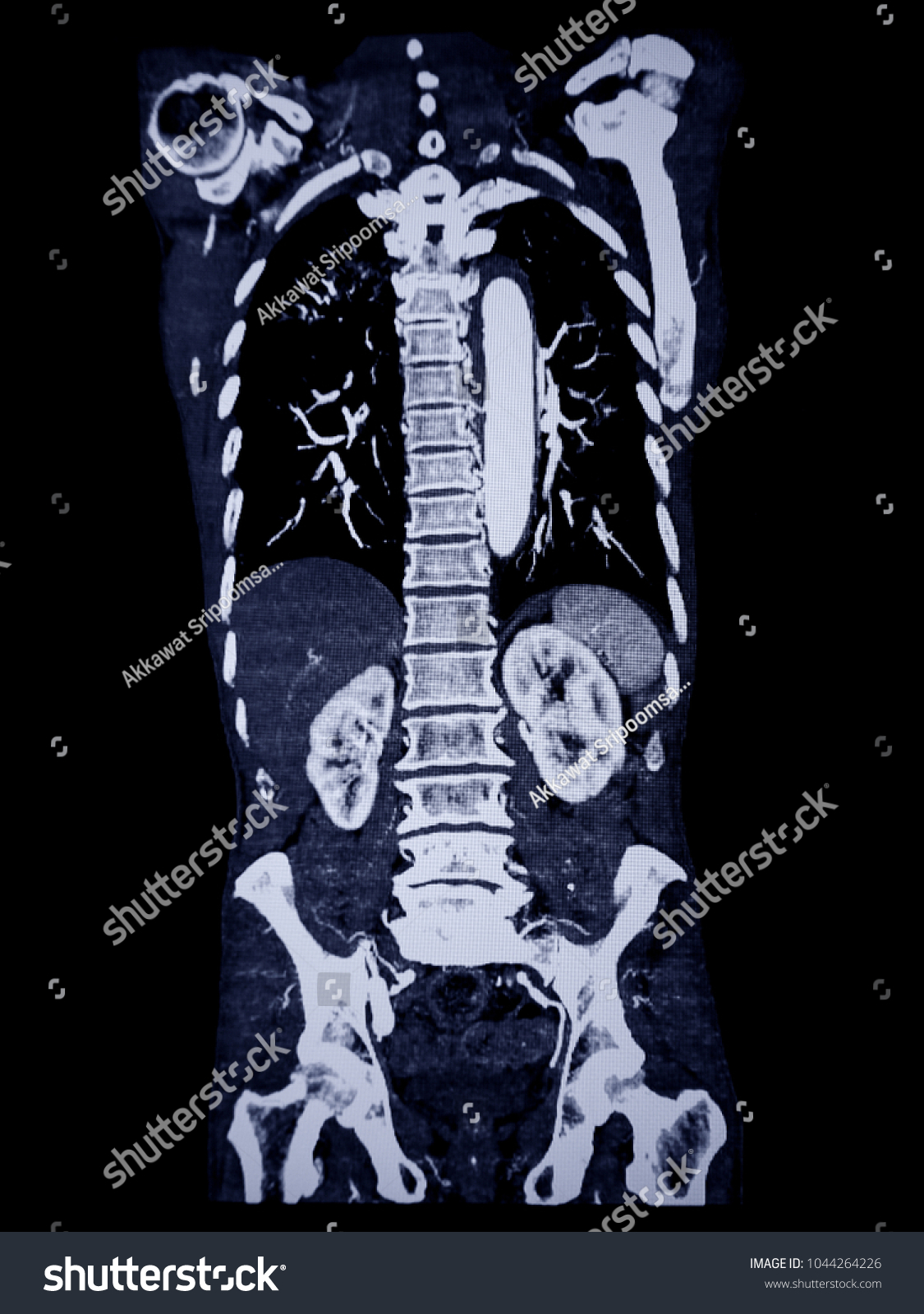 Computer Tomography Body Angiography Stock Photo 1044264226 | Shutterstock