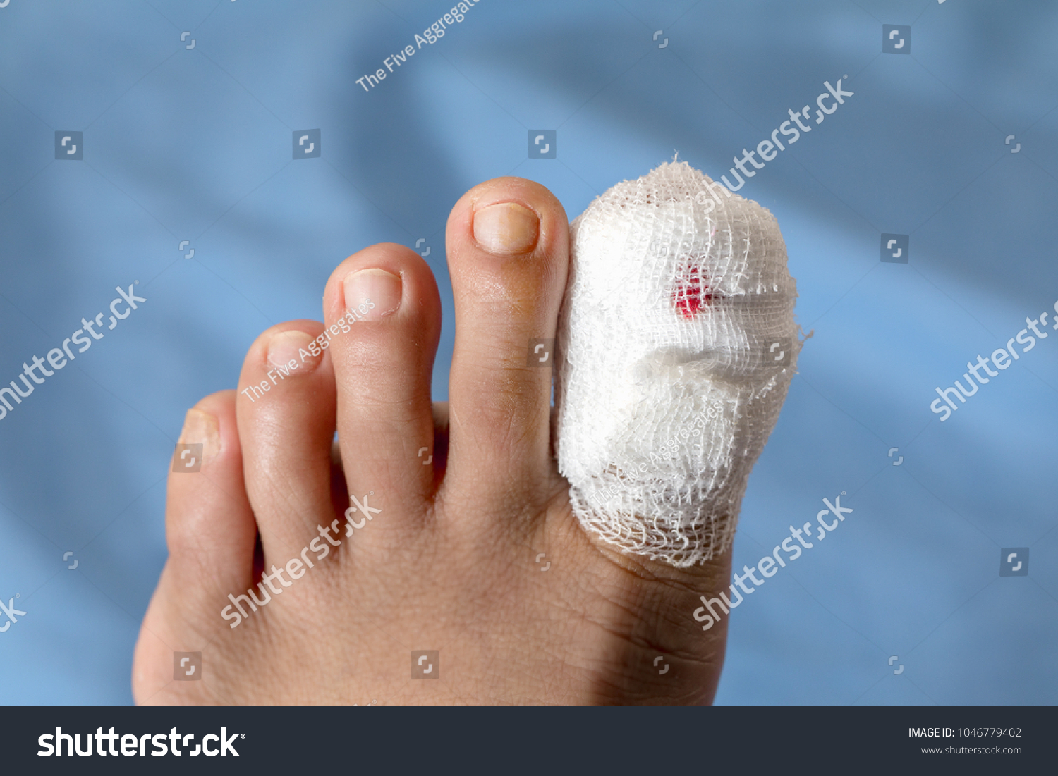 Начальная стадия гангрены большой палец на ноге