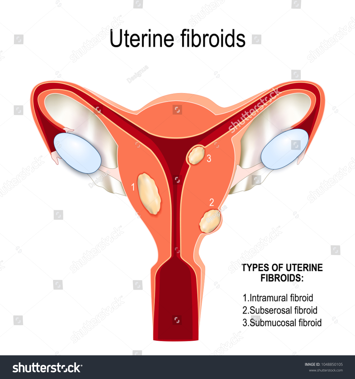 Types Uterine Fibroids Intramural Subserosal Submucosal Stock Illustration 1048850105 Shutterstock 