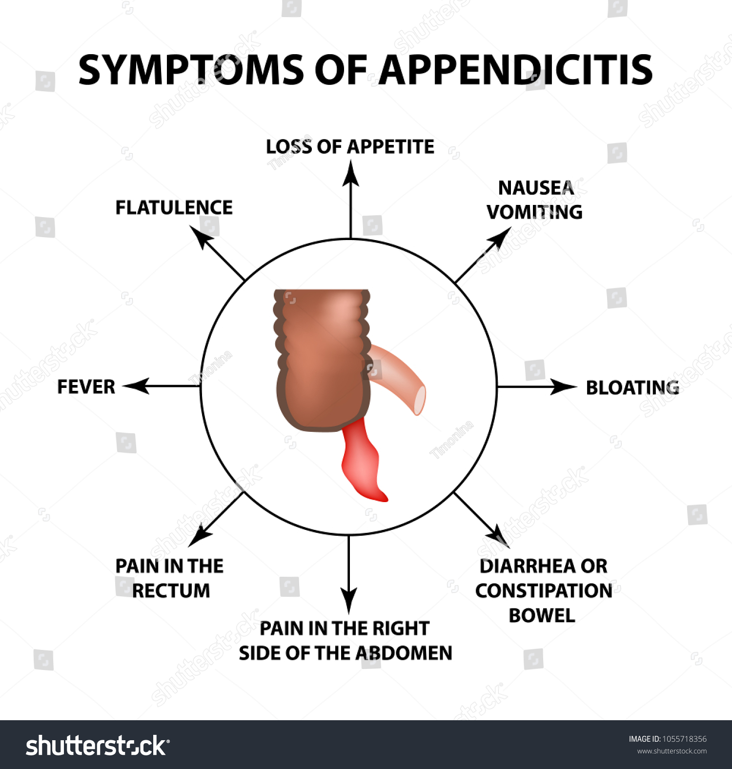 Symptoms Appendicitis Inflammation Appendix Infographics Vector Stock ...