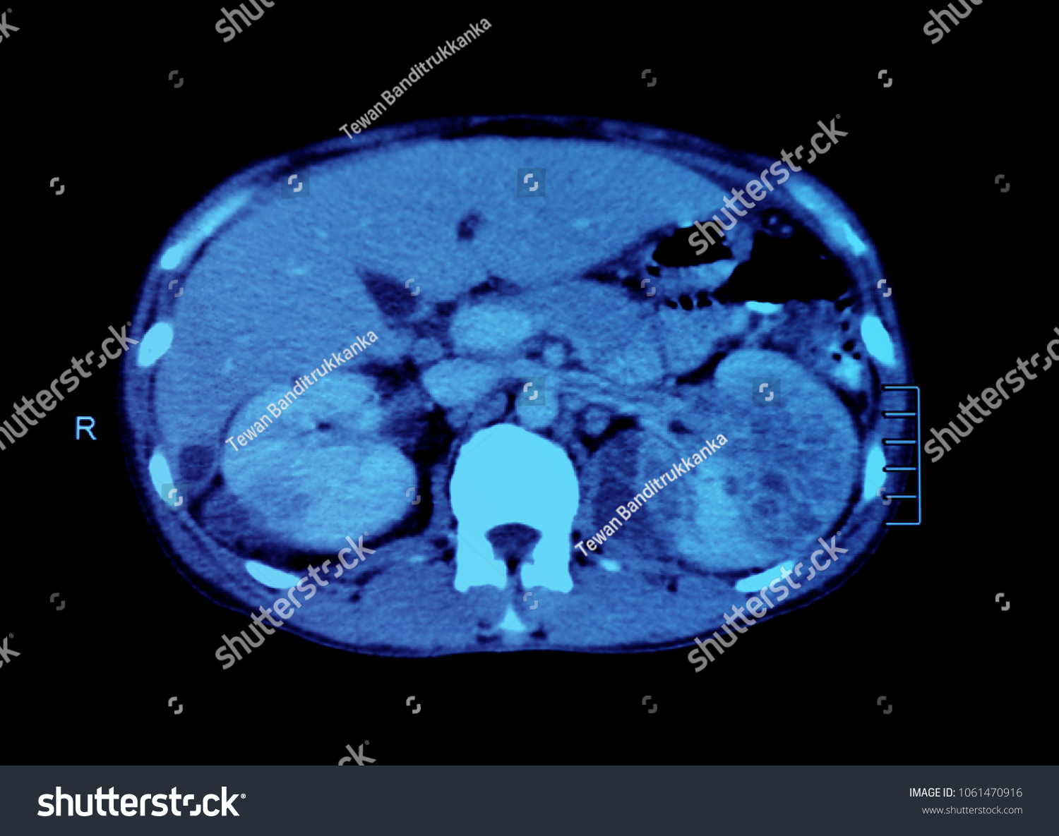 ct scan abdomen hindi