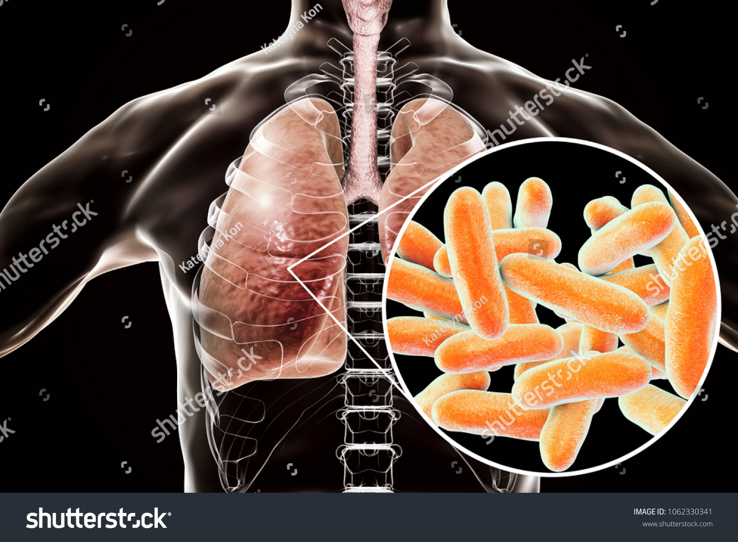 Legionella Pneumophila Bacteria Human Lungs 3d Stock Illustration ...