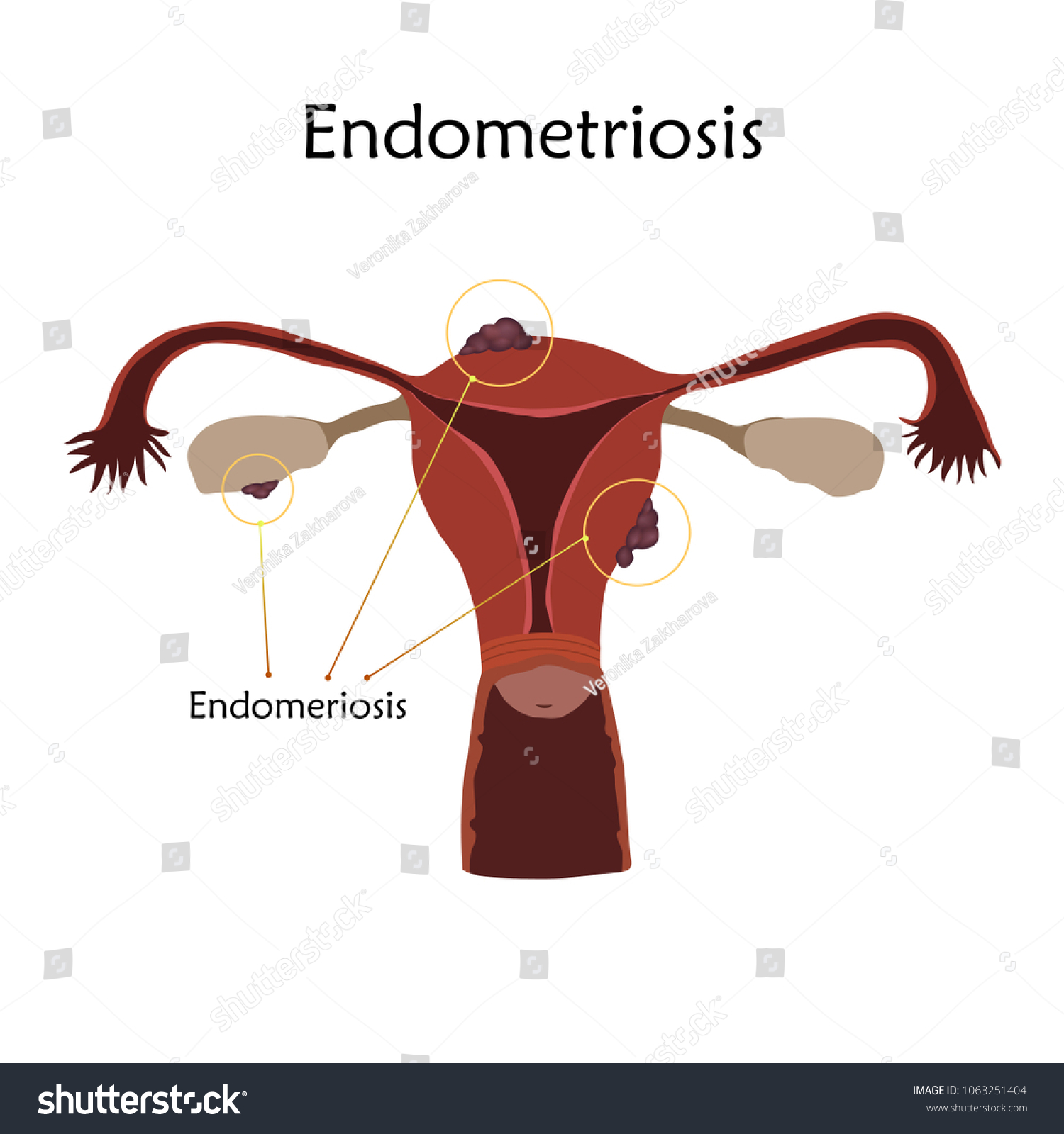 Endometriosis Human Realistic Uterus Anatomy Flat Stock Vector (Royalty ...