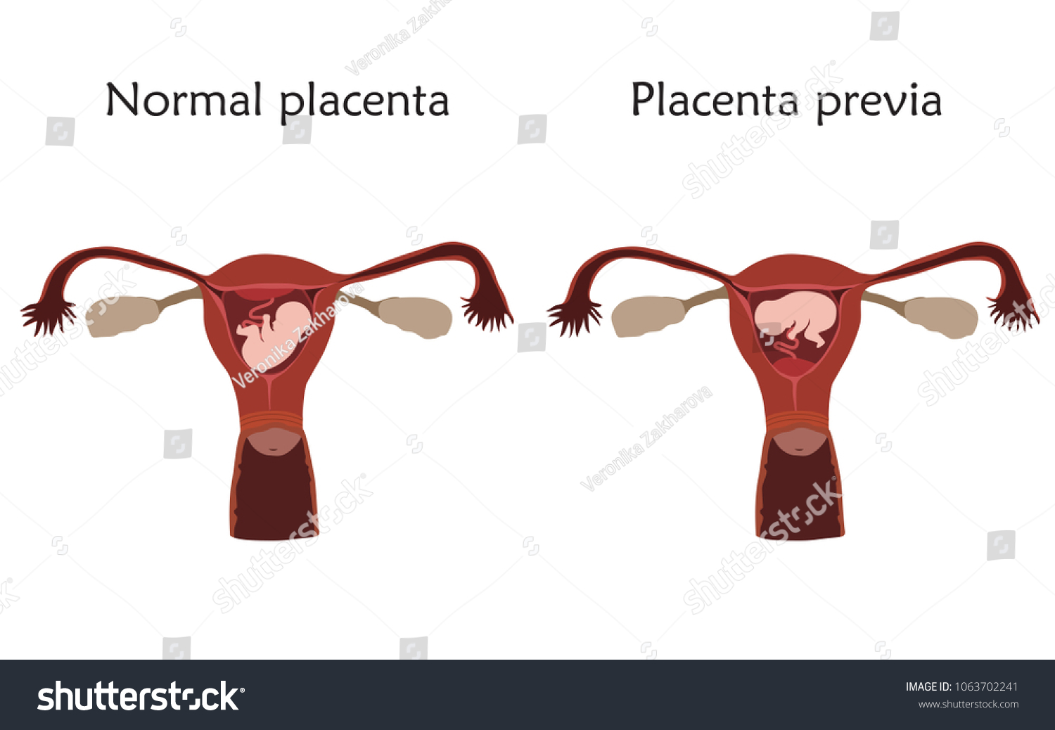 Placenta Previa Normal Pregnancy Embryo Fetus Stock Vector Royalty Free 1063702241 Shutterstock 