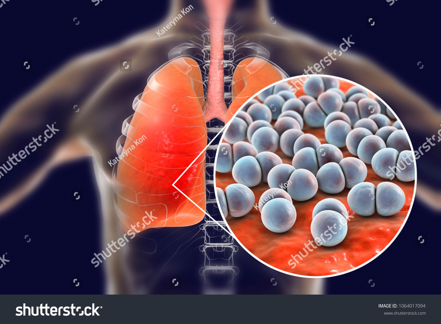 what-disease-does-streptococcus-cause