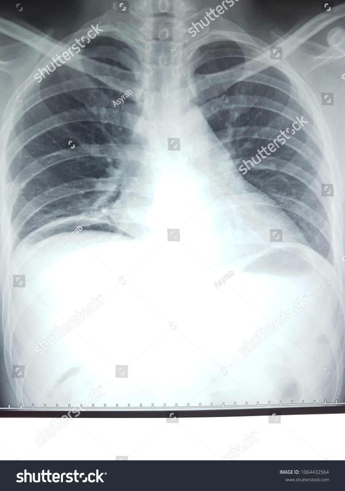 Air Under Diaphragm Chest Xray Erect Stock Photo 1064432564 | Shutterstock