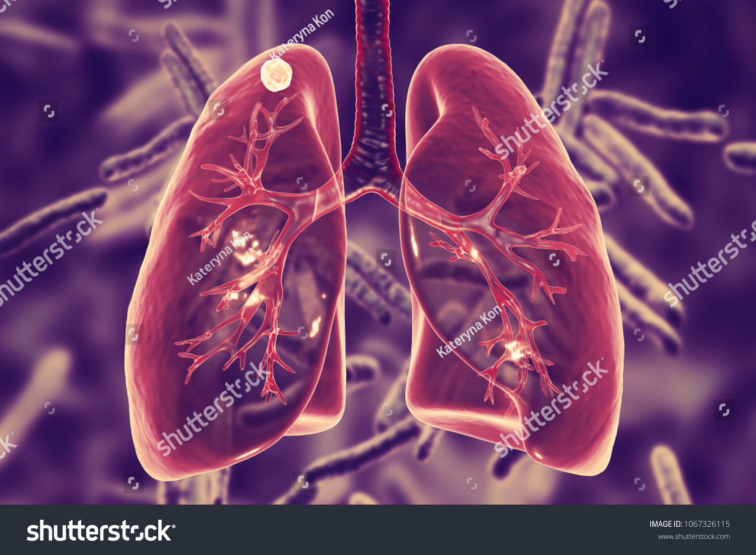 137 Necrosis In The Lung Images, Stock Photos & Vectors | Shutterstock