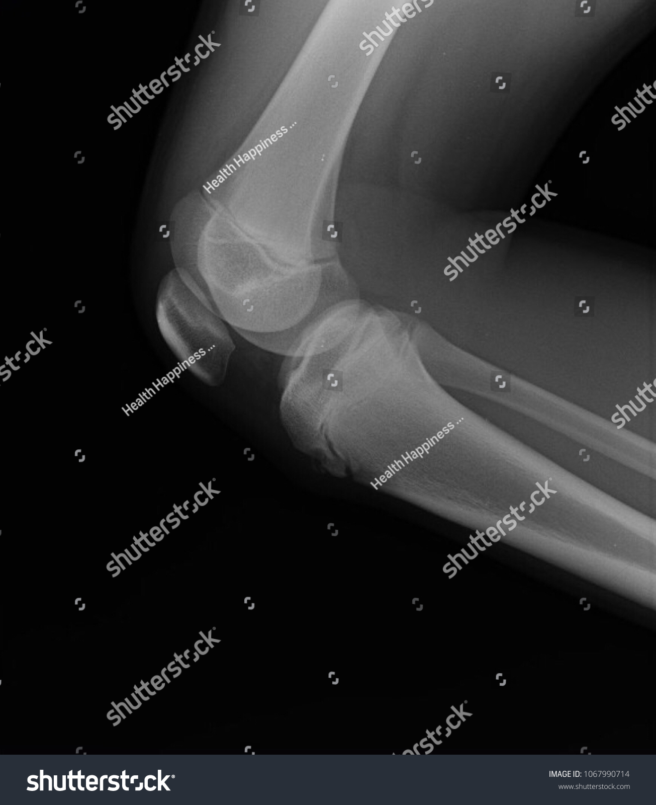 Blurred Osteoarthritis Oa Knee Film Xray Stock Photo 1067990714 ...