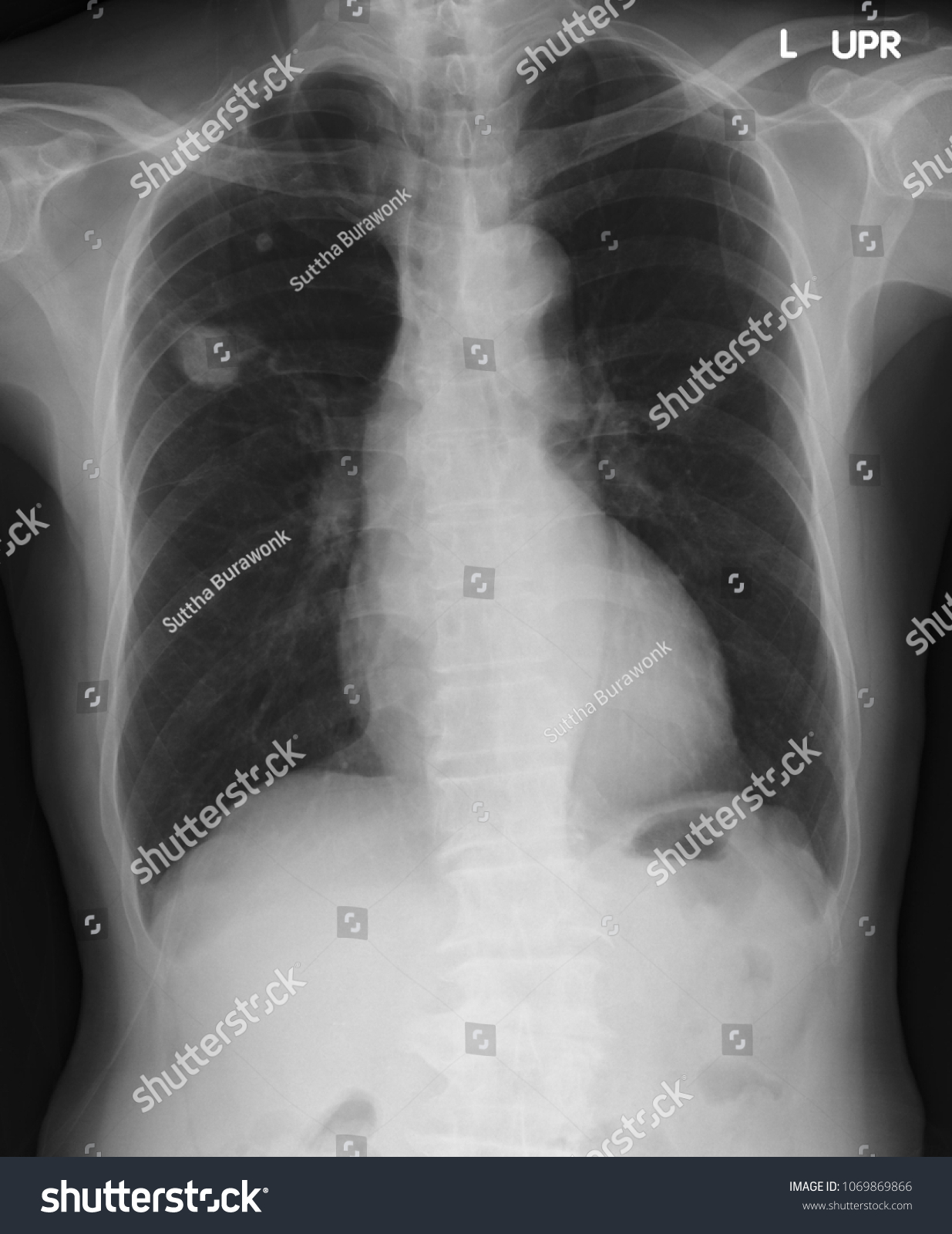 Chest Xray Shows Mass Right Upper Stock Photo 1069869866 | Shutterstock