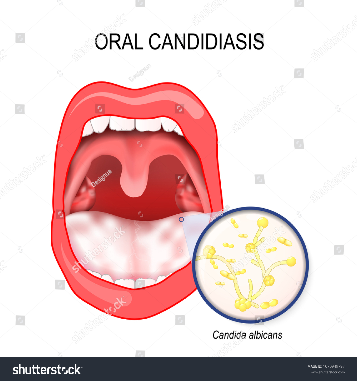 Oral Candidiasis Oral Thrush That Occurs Stock Illustration 1070949797 ...