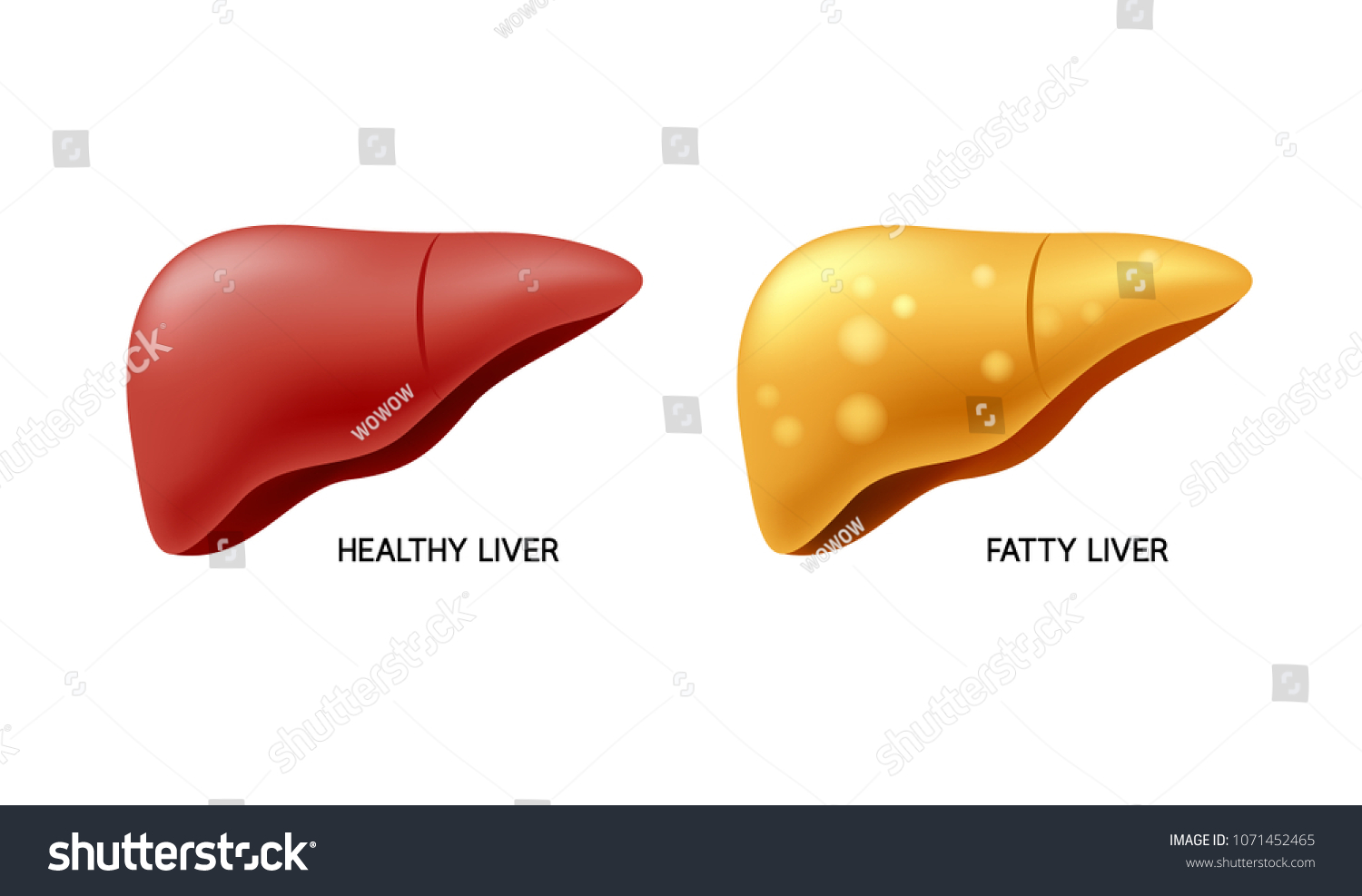 Comparison Healthy Liver Fatty Live Liver Stock Vector (Royalty Free ...