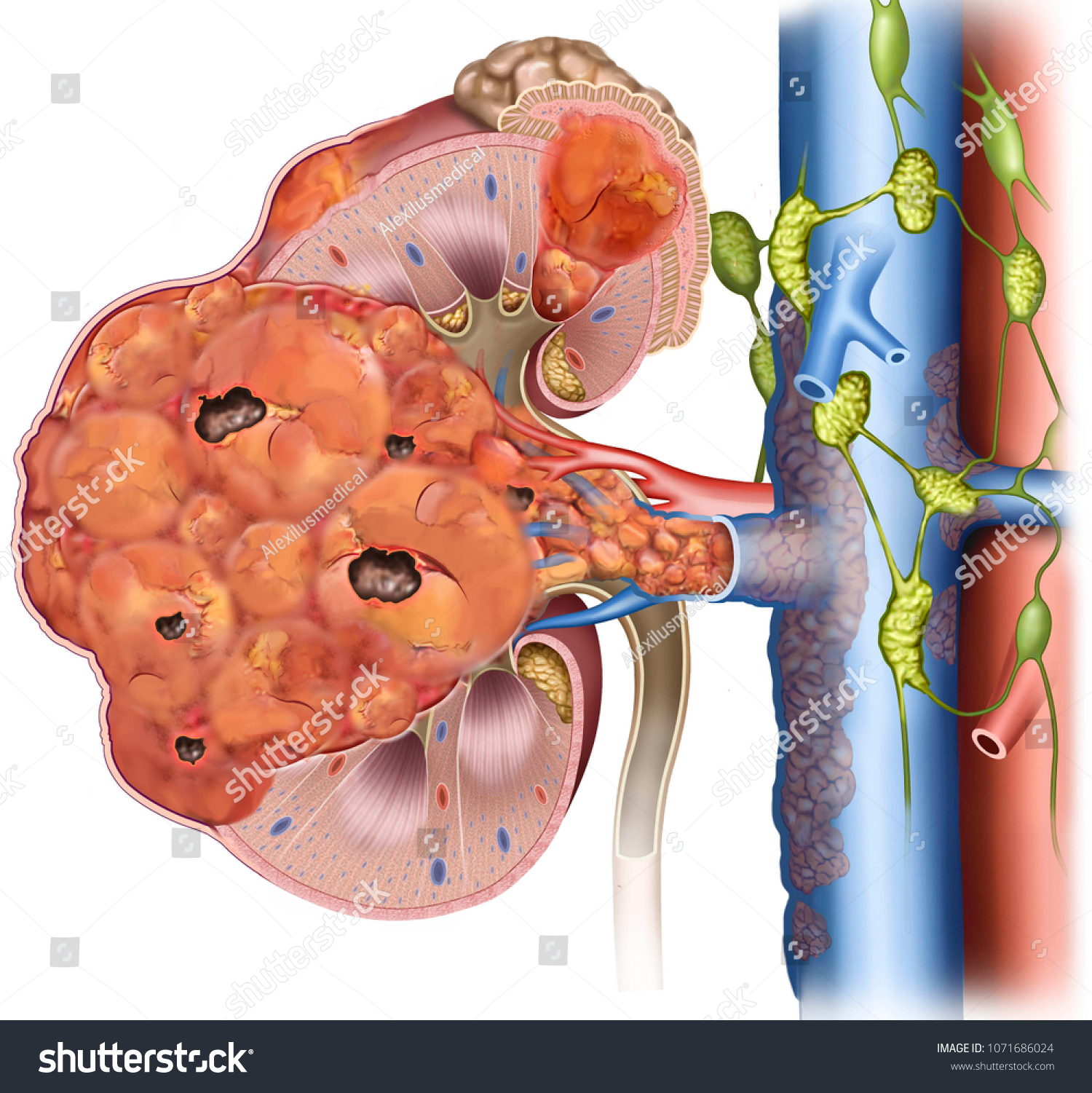 1-stage-4-kidney-cancer-images-stock-photos-vectors-shutterstock