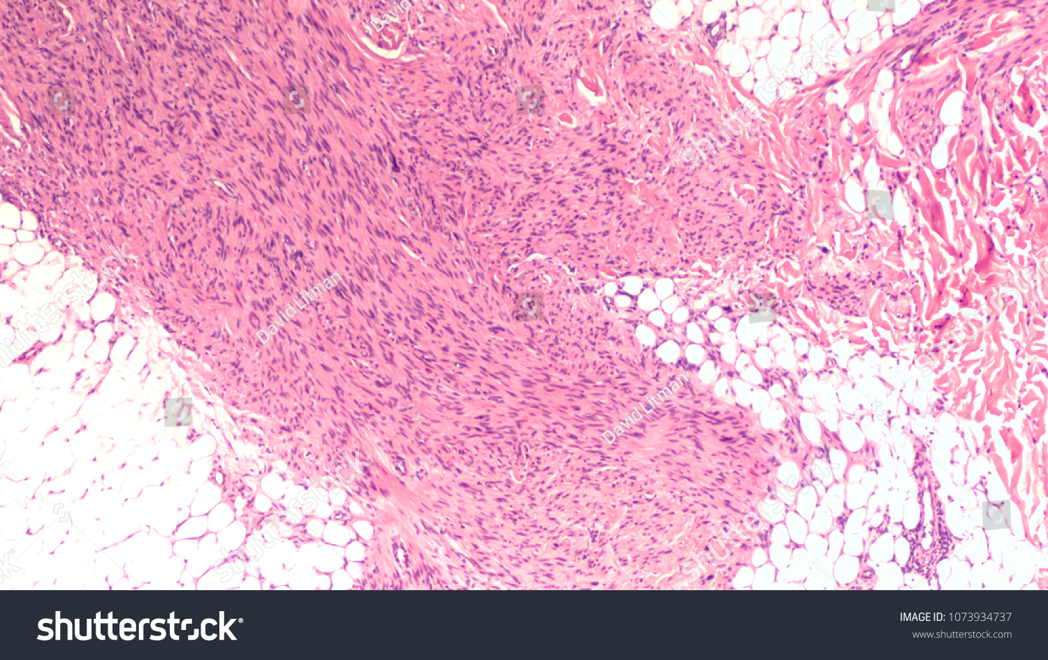 Photomicrograph Malignant Peripheral Nerve Sheat Tumor Stock Photo ...