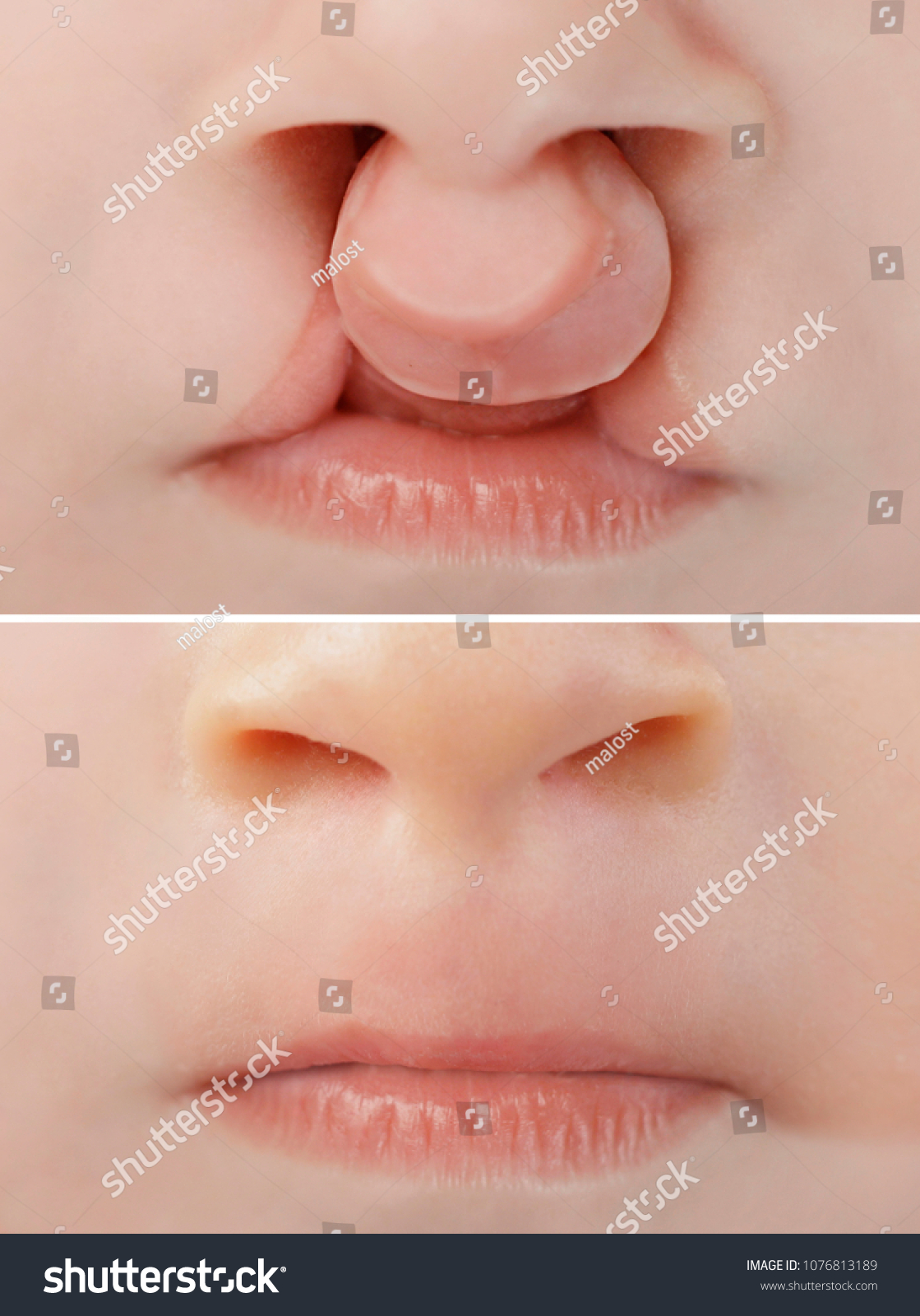 Bilateral Lip Palate Cleft Before After Stock Photo 1076813189
