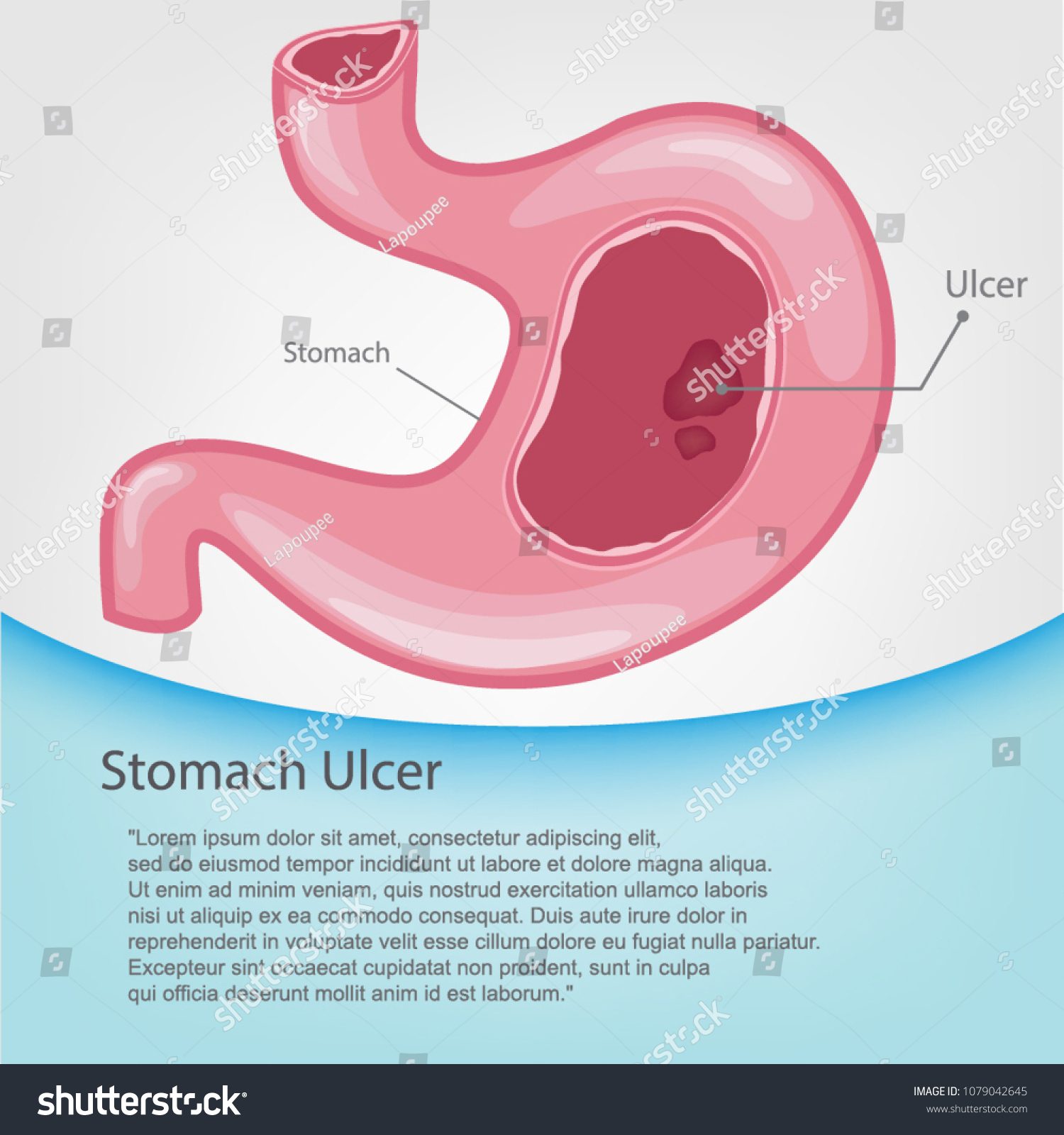 Cartoon Vector Illustration Stomach Ulcers Stock Vector (Royalty Free ...