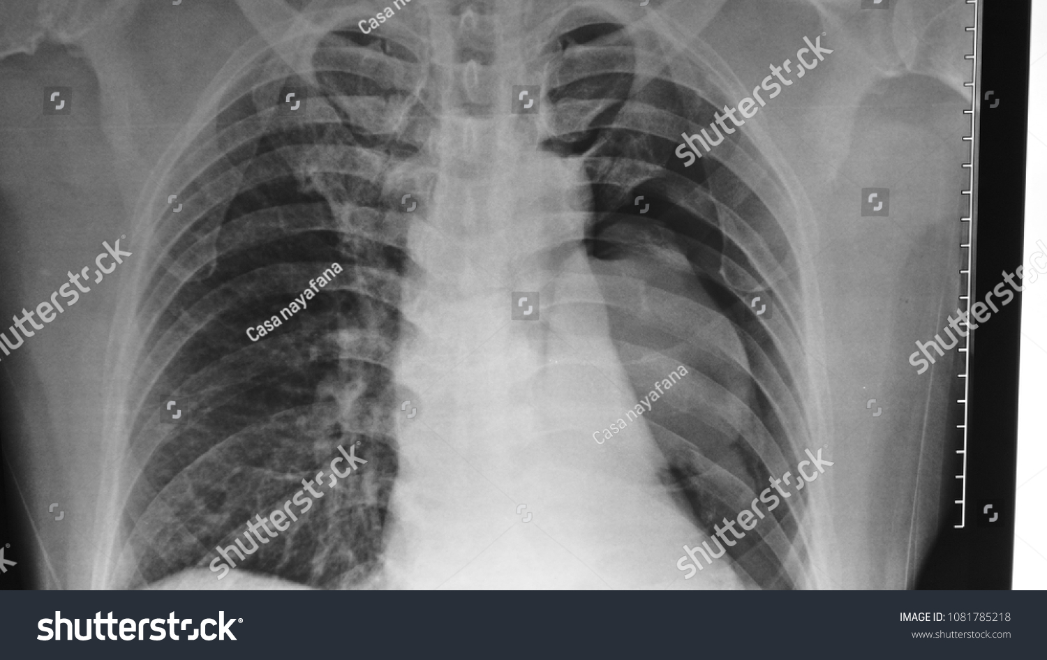 Left Lung Collapse Pneumothorax Multiple Rib Stock Photo 1081785218 ...