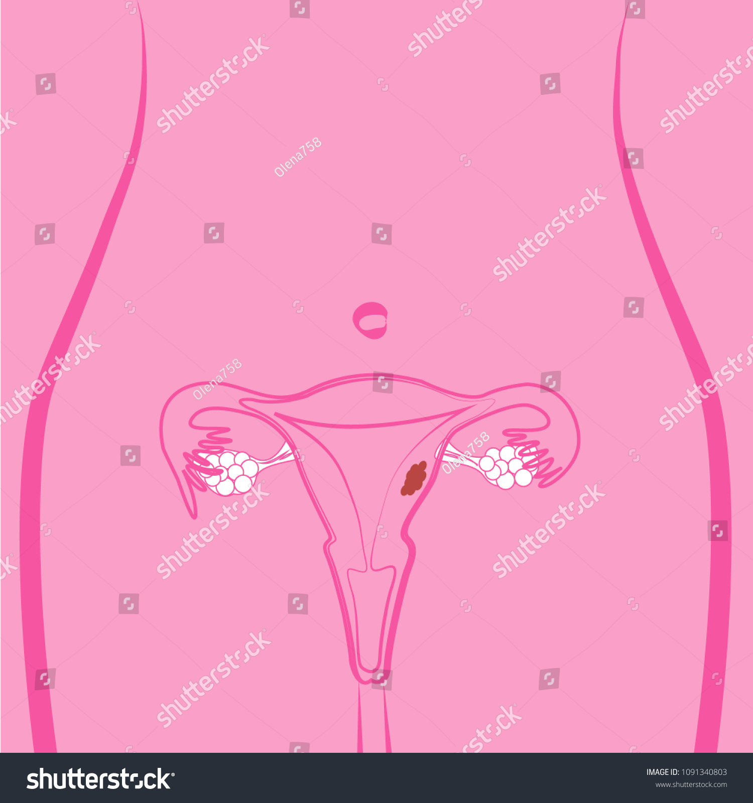 Uterine Fibroid Vector Illustration Stock Vector Royalty Free