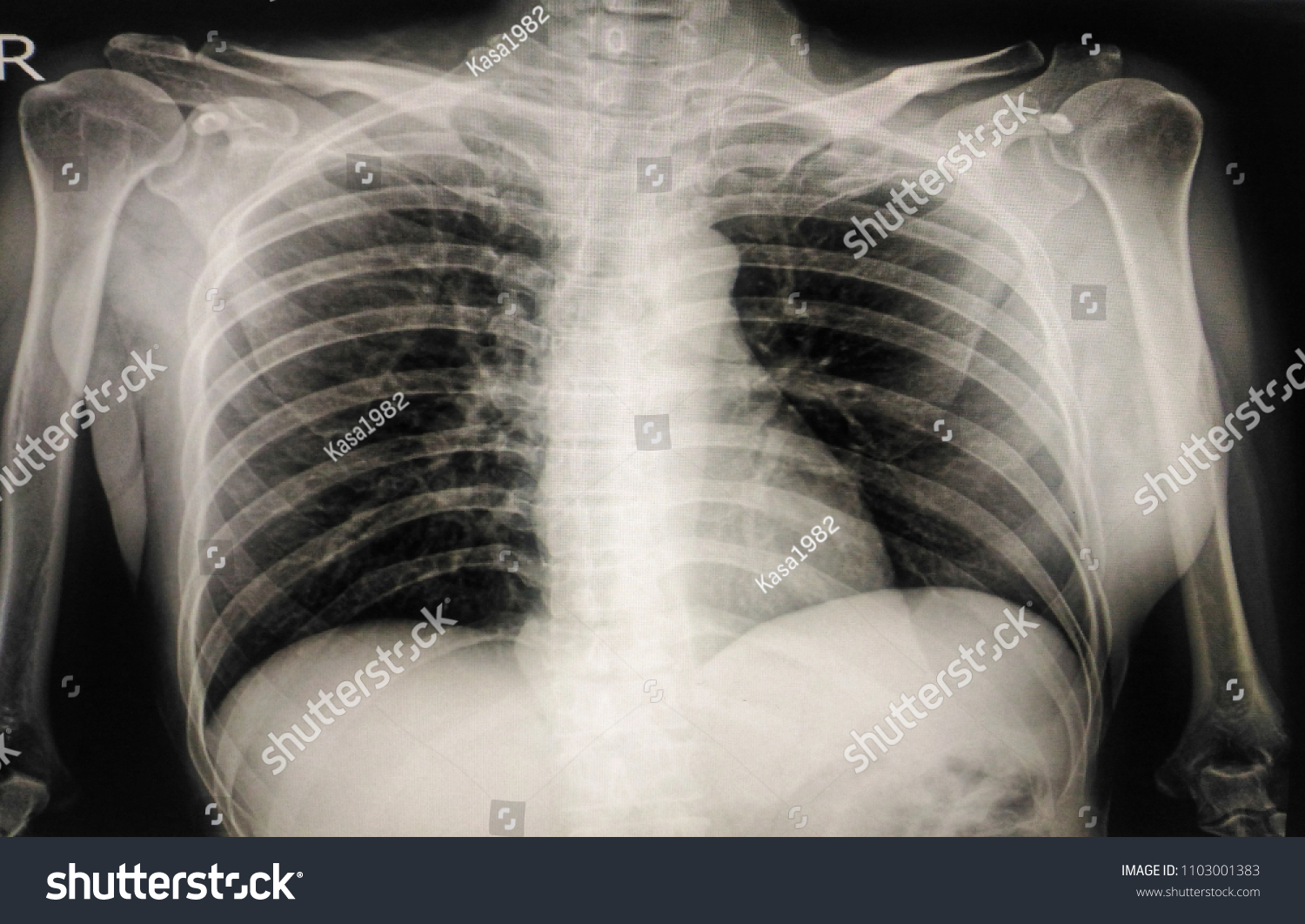 Chest Xrat 47 Year Old Woman Stock Photo 1103001383 | Shutterstock