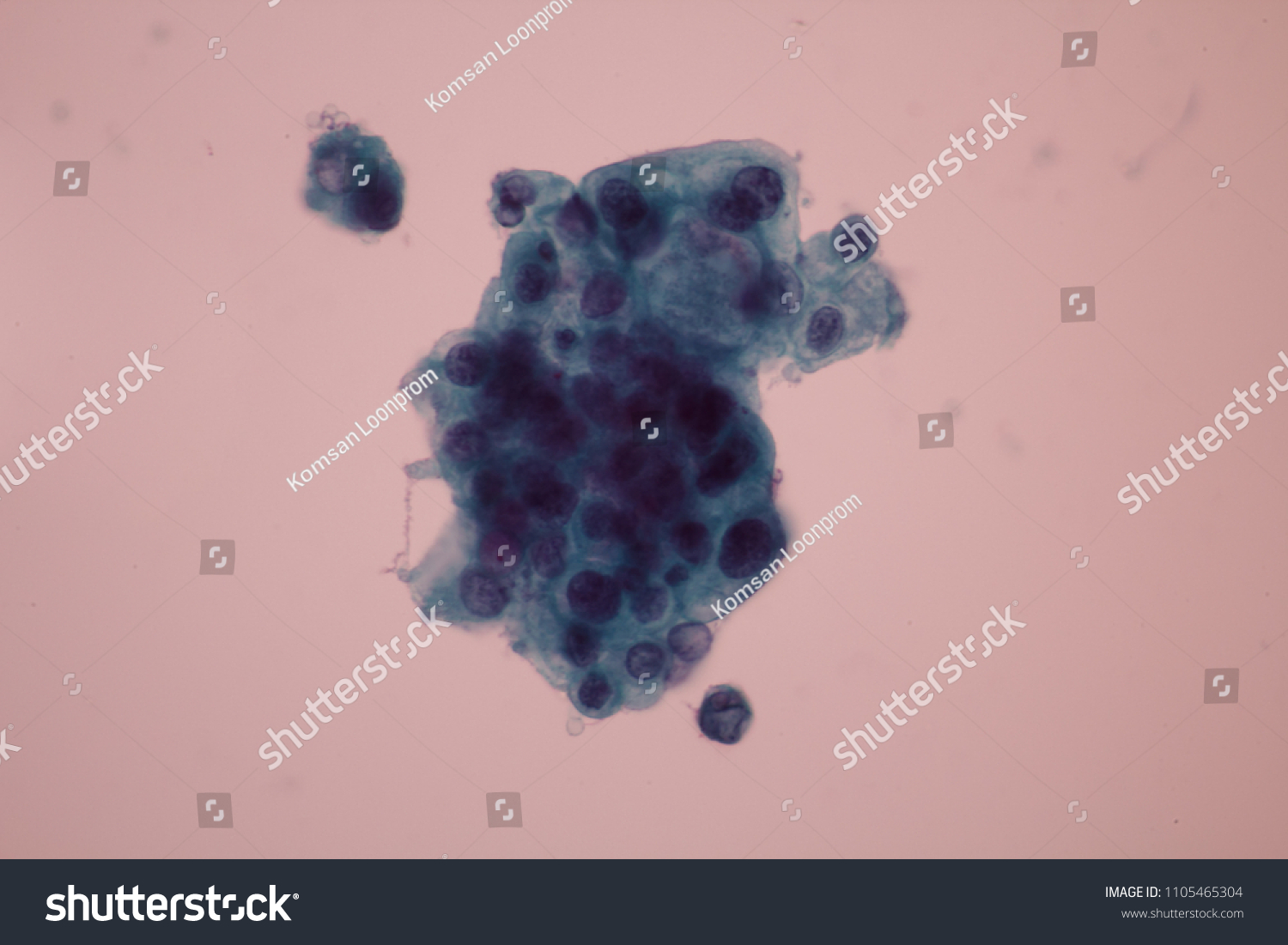 View Microscopic Abnormal Cells Pap Smear Stock Photo 1105465304   Stock Photo View In Microscopic Of Abnormal Cells In Pap Smear Slide Cervical Screening For Woman Health Check 1105465304 