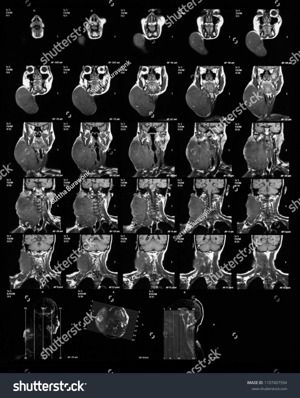 Coronal View Mri Scan Neck Without Stock Photo 1107407594 | Shutterstock