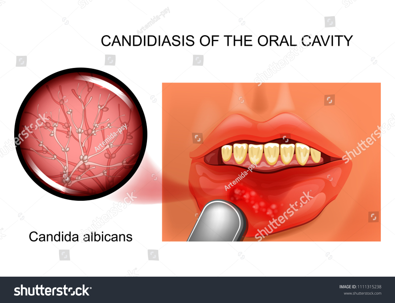 Vector Illustration Oral Candidiasis Causative Agent Stock Vector