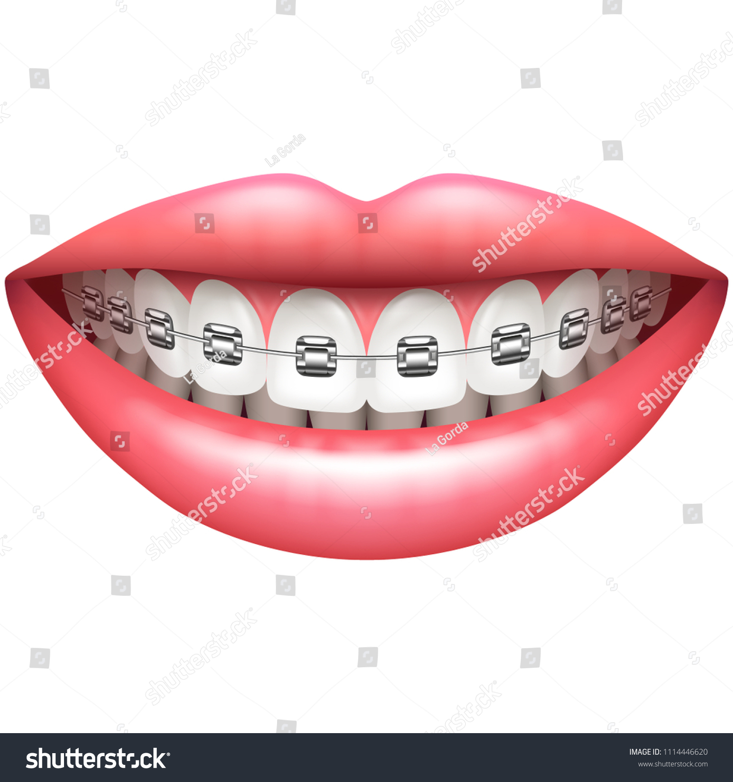 Teeth Braces Beautiful Woman Smile Isolated Stock Vector (Royalty Free ...