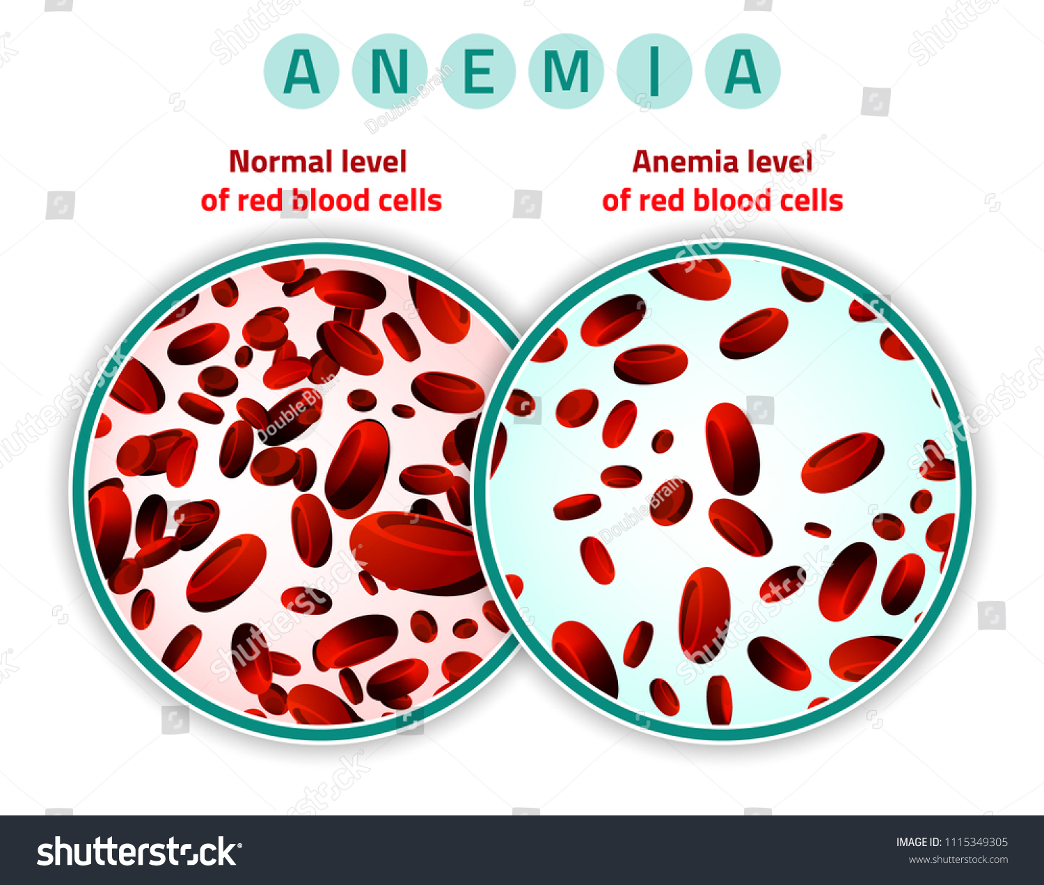 Normal Level Red Blood Cells Comparison Stock Vector (Royalty Free ...