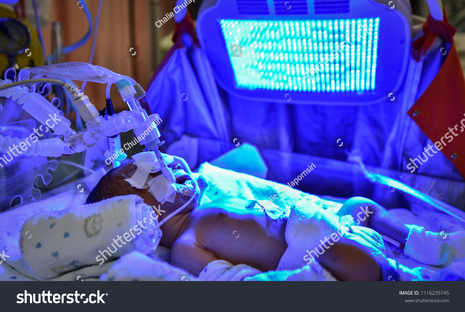 sick-baby-neonatal-jaundice-high-bilirubin-stock-photo-1116235745