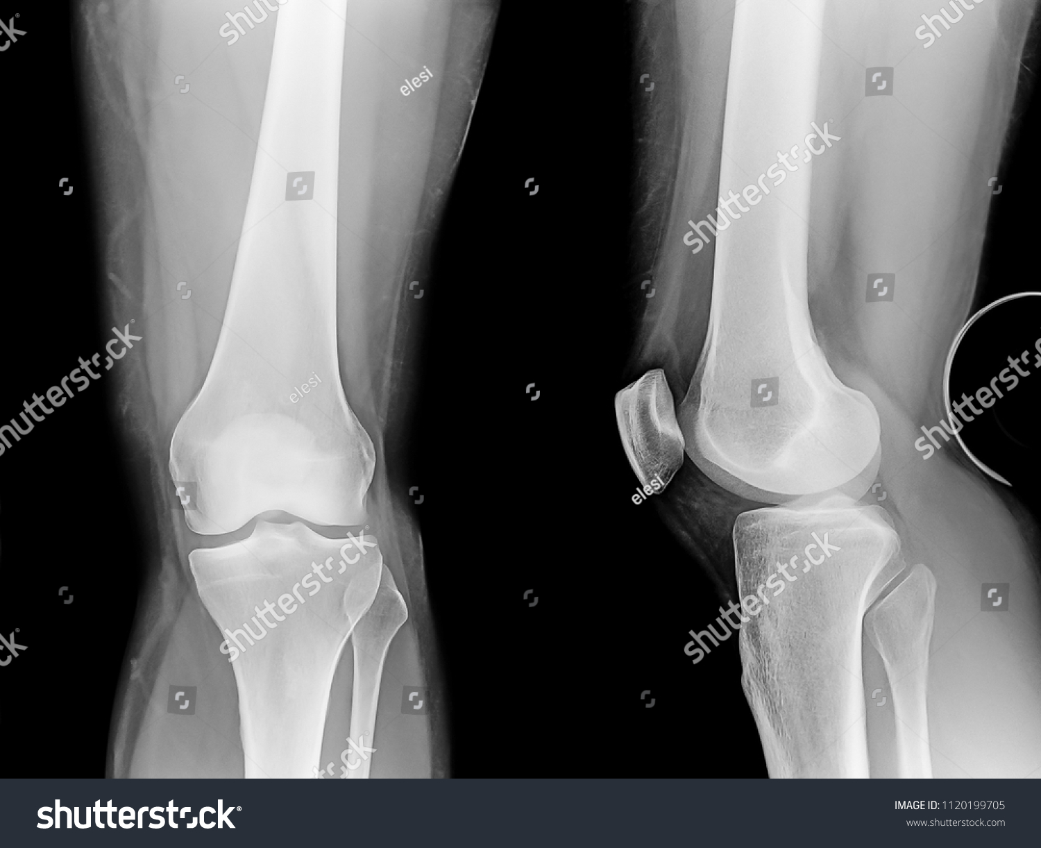 Xray Knee Lateral Posterior Views Stock Photo 1120199705 Shutterstock.