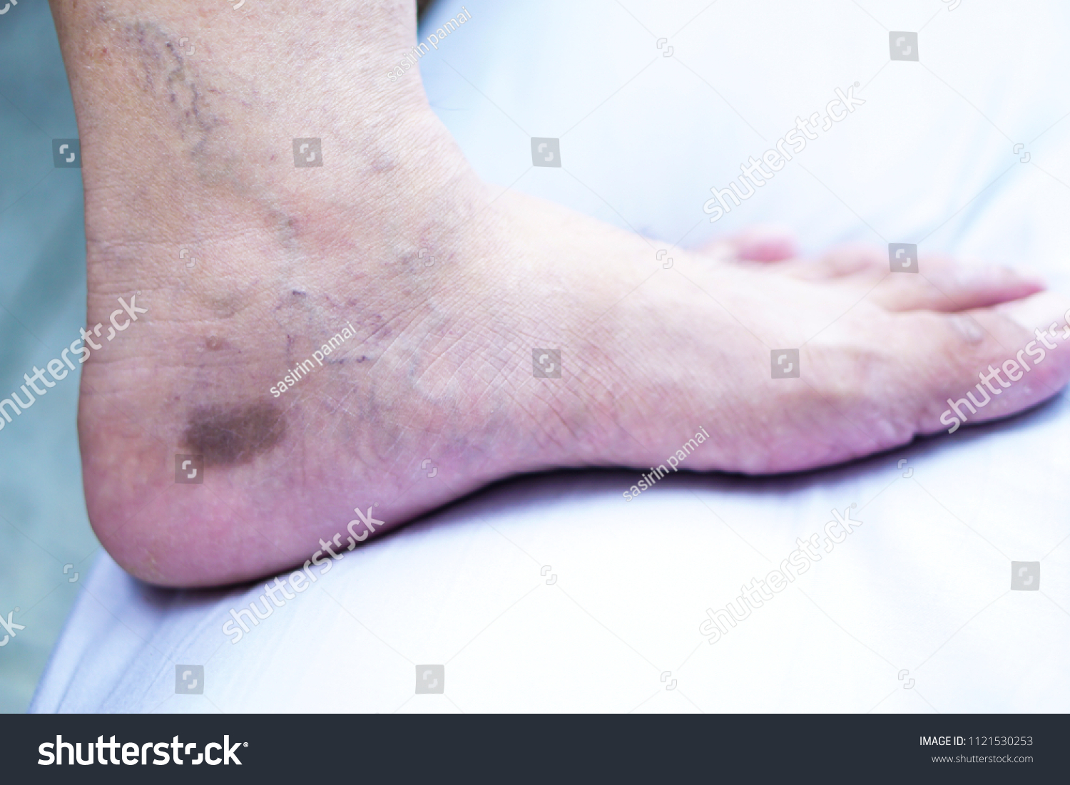 Dermatitis Foot Have Dark Circular Appearance Stock Photo 1121530253 ...