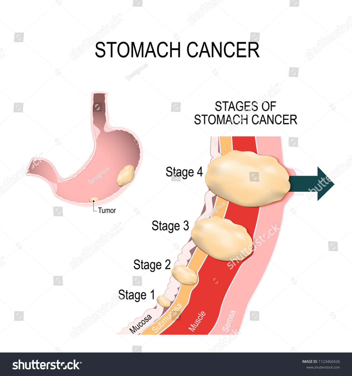 Clinical Stages Stomach Cancer Classification Malignant Stock Vector Royalty Free 1123460426 1402