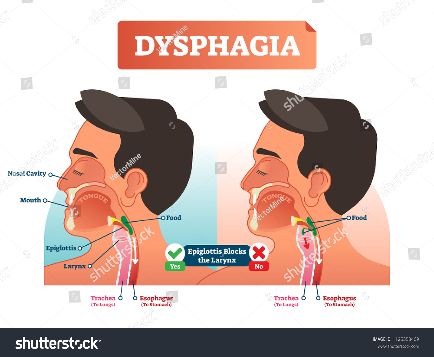 335 Dysphagia Vector Images, Stock Photos & Vectors | Shutterstock