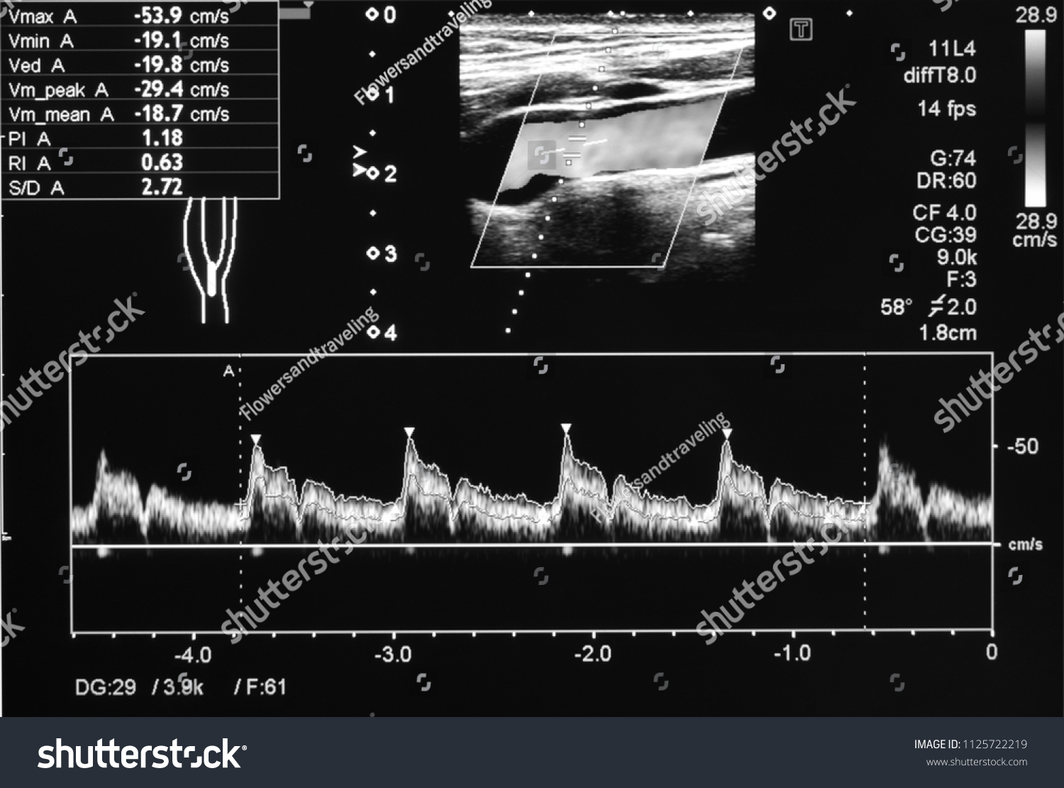 Ultrasound Doppler Carotid Artery Stock Photo 1125722219 | Shutterstock