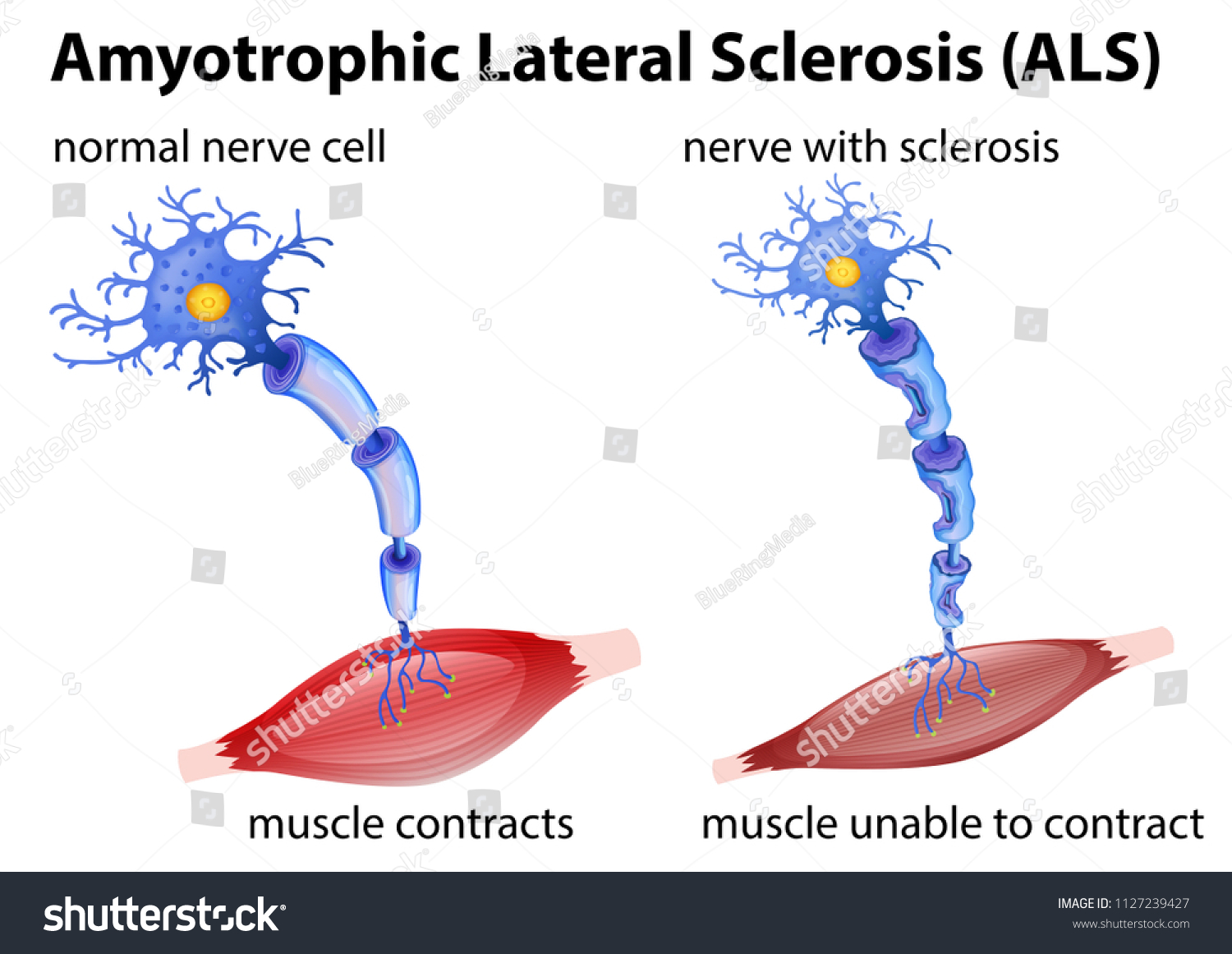 Amyotrophic Lateral Sclerosis Concept Illustration Stock Vector ...