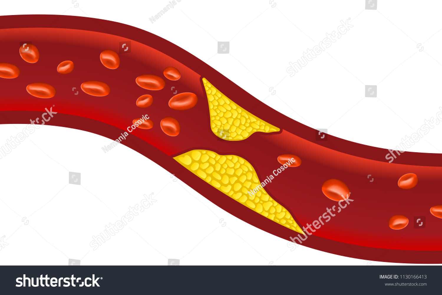 Atherosclerosis Blocked Blood Vessel Stock Vector (Royalty Free ...