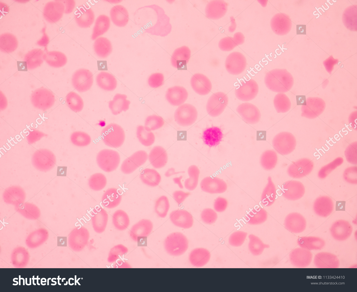 Thalassemia Blood Smear Abnormal Red Blood Stock Photo 1133424410