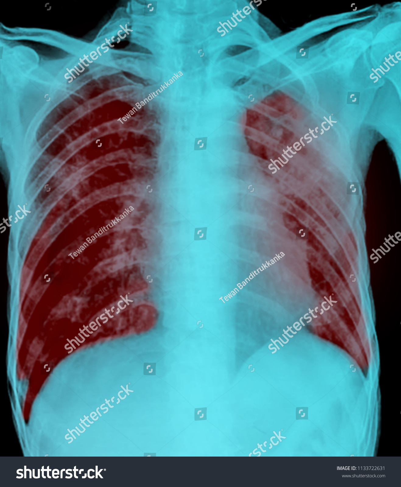 Pulmonary Tuberculosis Film Xray Chest Show Stock Photo 1133722631 ...