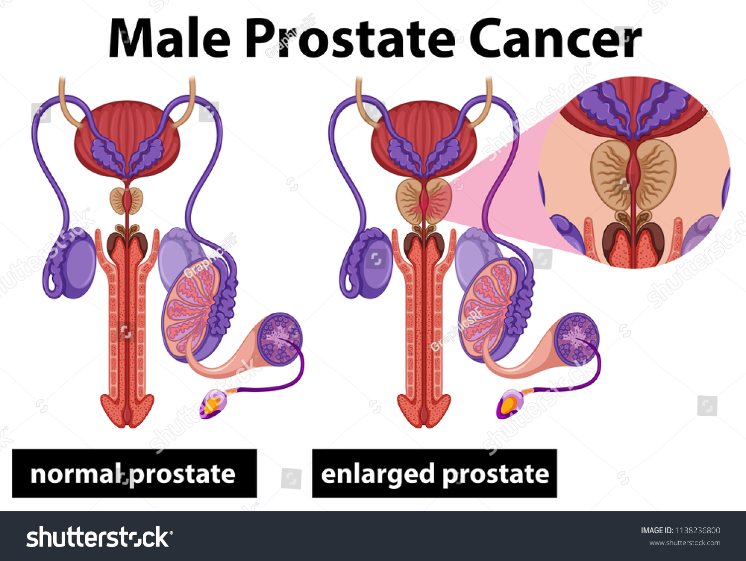 Human Male Prostate Cancer Illustration Stock Vector (Royalty Free ...