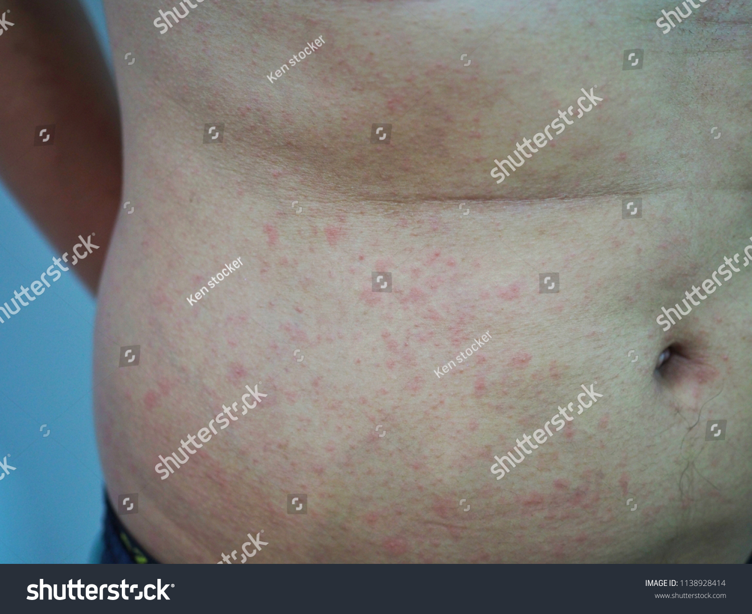 Close Skin Dermatitis Rash Stock Photo 1138928414 | Shutterstock