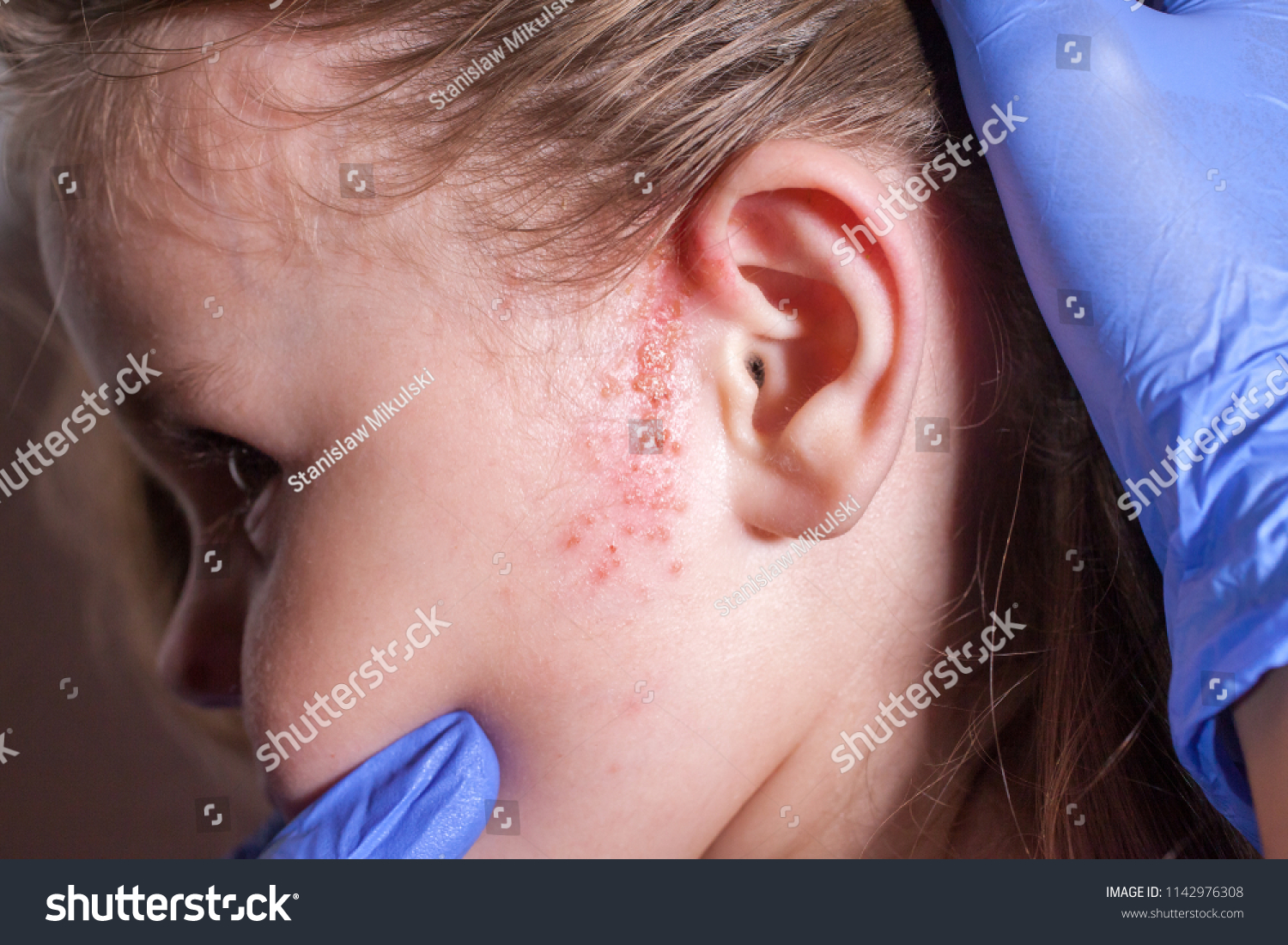 allergic-rash-on-face-child-stock-photo-1142976308-shutterstock