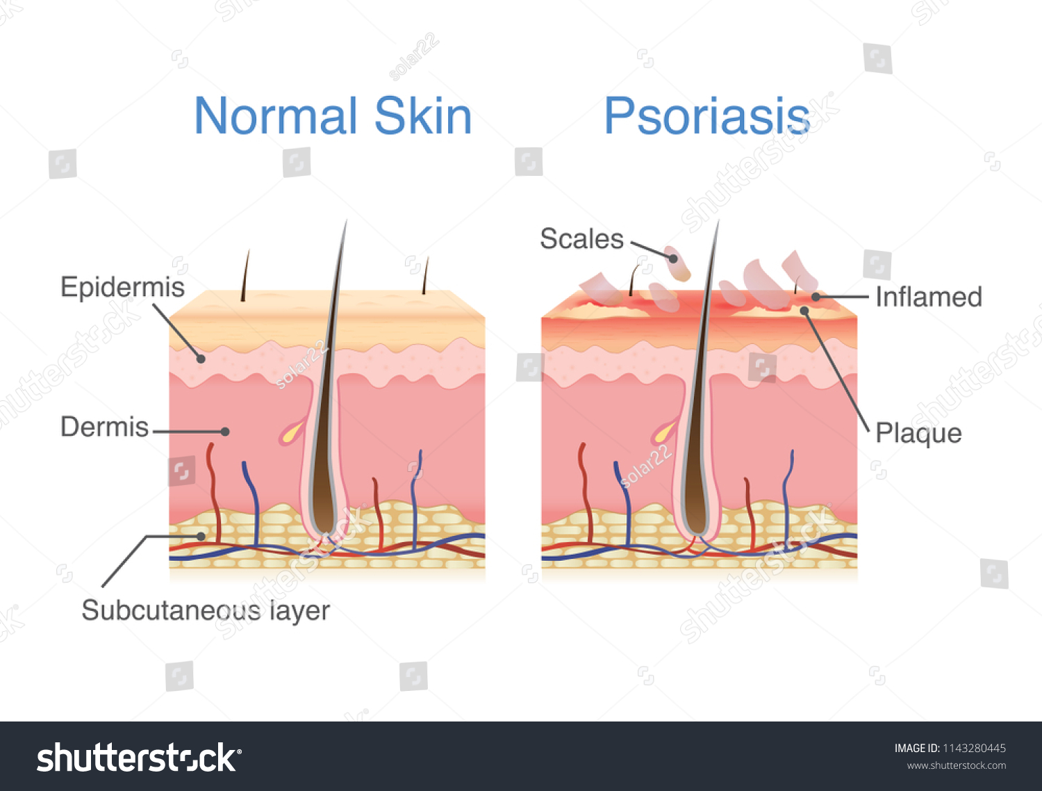 Normal Skin Layer Skin When Plaque Stock Vector (Royalty Free ...