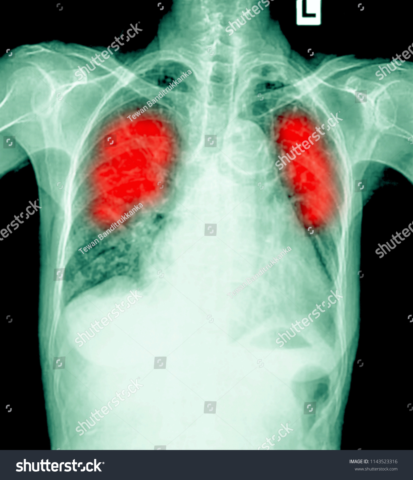 Lung Cancer Pleural Effusion Stock Photo 1143523316 | Shutterstock